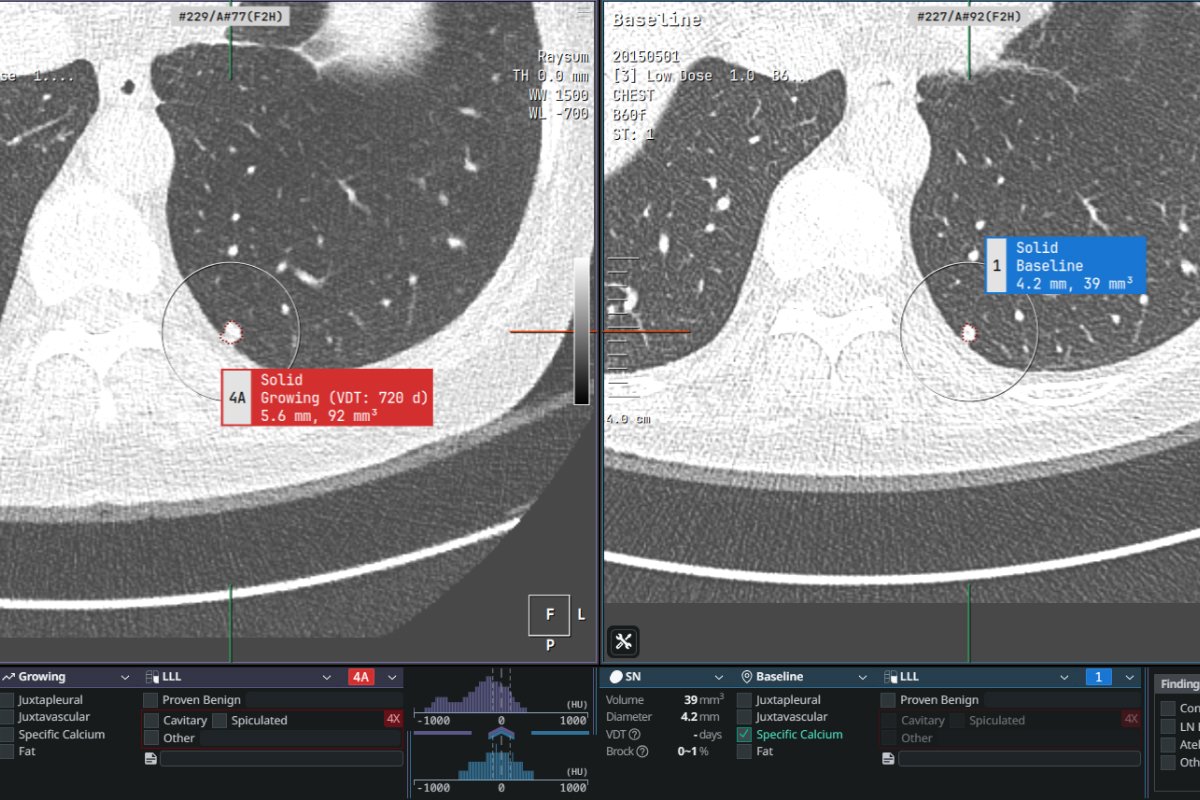 Coreline Soft Deep Dive: Germany Wrote Lung-Screening AI Into Law, and a Small Korean Company Signed 95 German Deals in Seven Months