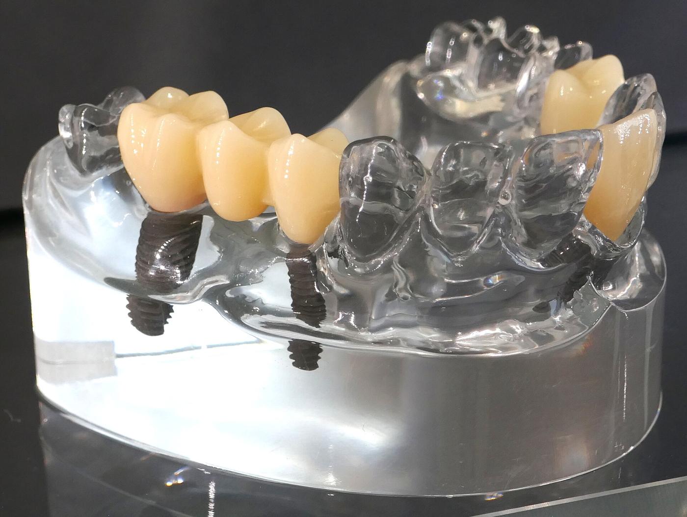A transparent jaw model on display showing dental implants beneath a row of ceramic crowns.