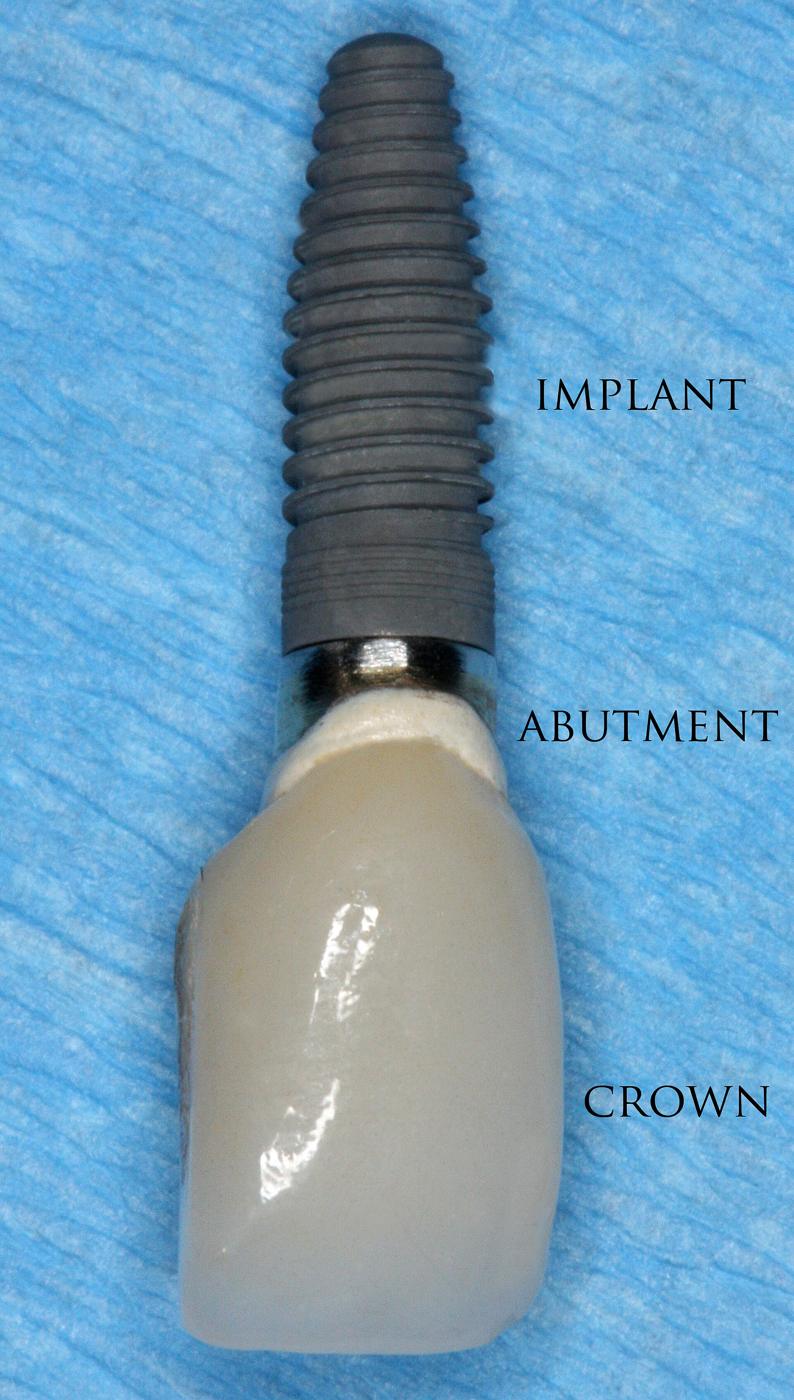 A dental implant model showing the three parts: the threaded titanium implant screw, the abutment and the white crown on top, each labelled.